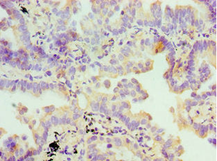 Immunohistochemistry of paraffin-embedded human lung cancer using FDFT1 Antibody at dilution of 1:100