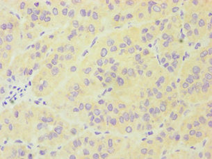Immunohistochemistry of paraffin-embedded human liver cancer using FES Antibody at dilution of 1:100Rabbit anti-Human FES Polyclonal Antibody