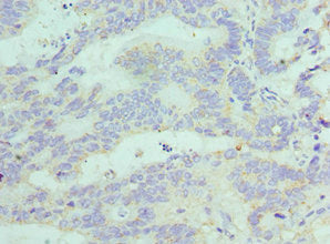 Immunohistochemistry of paraffin-embedded human colon cancer using FGF1 Antibody at dilution of 1:100Rabbit anti-Human FGF1 Polyclonal Antibody