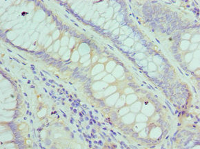 Immunohistochemistry of paraffin-embedded human colon cancer using the antibody at dilution of 1:100Rabbit anti-Human FGF1 Polyclonal Antibody