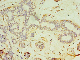 Immunohistochemistry of paraffin-embedded human breast cancer using FGF6 Antibody at dilution of 1:100Rabbit anti-Human FGF6 Polyclonal Antibody