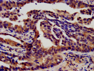 IHC image of FGFR3 Antibody diluted at 1:450 and staining in paraffin-embedded human lung cancer performed on a Leica BondTM system. After dewaxing and hydration, antigen retrieval was mediated by high pressure in a citrate buffer (pH 6.0). Section was blocked with 10% normal goat serum 30min at RT. Then primary antibody (1% BSA) was incubated at 4°C overnight. The primary is detected by a biotinylated secondary antibody and visualized using an HRP conjugated SP system.Rabbit anti-Human FGFR3 Polyclonal Antibody