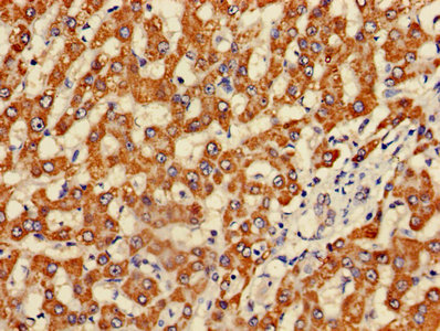 Immunohistochemistry of paraffin-embedded human liver cancer using FH Antibody at dilution of 1:100Rabbit anti-Human FH Polyclonal Antibody