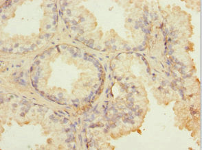 Immunohistochemistry of paraffin-embedded human prostate cancer using FIBP Antibody at dilution of 1:100Rabbit anti-Human FIBP Polyclonal Antibody