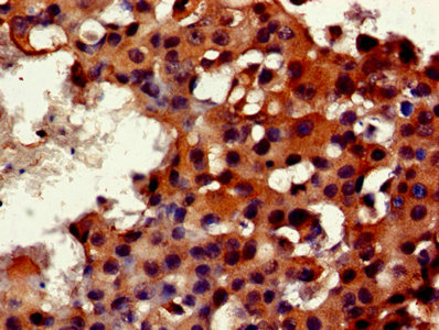 Immunohistochemistry of paraffin-embedded human breast cancer using FKBP3 Antibody at dilution of 1:100Rabbit anti-Human FKBP3 Polyclonal Antibody