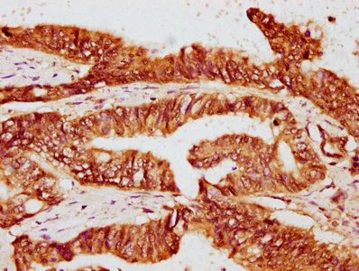 IHC image of FKBP4 Antibody diluted at 1:400 and staining in paraffin-embedded human colon cancer performed on a Leica BondTM system. After dewaxing and hydration, antigen retrieval was mediated by high pressure in a citrate buffer (pH 6.0). Section was blocked with 10% normal goat serum 30min at RT. Then primary antibody (1% BSA) was incubated at 4°C overnight. The primary is detected by a biotinylated secondary antibody and visualized using an HRP conjugated SP system.Rabbit anti-Human FKBP4 Polyclonal Antibody