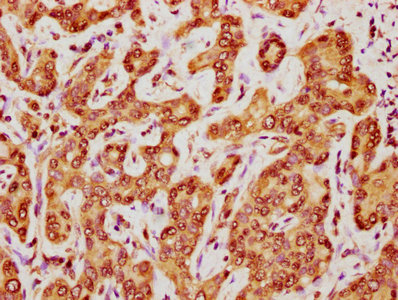 IHC image of FKBP4 Antibody diluted at 1:400 and staining in paraffin-embedded human liver cancer performed on a Leica BondTM system. After dewaxing and hydration, antigen retrieval was mediated by high pressure in a citrate buffer (pH 6.0). Section was blocked with 10% normal goat serum 30min at RT. Then primary antibody (1% BSA) was incubated at 4°C overnight. The primary is detected by a biotinylated secondary antibody and visualized using an HRP conjugated SP system.Rabbit anti-Human FKBP4 Polyclonal Antibody