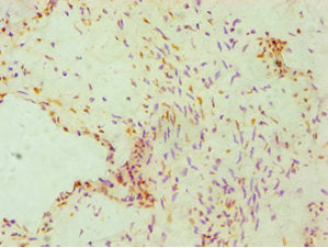 Immunohistochemistry of paraffin-embedded human cervical cancer using FKBP4 Antibody at dilution of 1:100Rabbit anti-Human FKBP4 Polyclonal Antibody