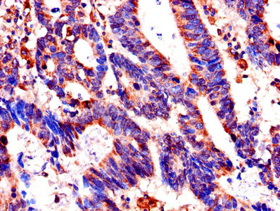 Immunohistochemistry of paraffin-embedded human colon cancer using FKBP6 Antibody at dilution of 1:100Rabbit anti-Human FKBP6 Polyclonal Antibody