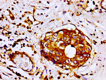 Immunohistochemistry of paraffin-embedded human breast cancer using the antibody at dilution of 1:100Rabbit anti-Human FLNA Polyclonal Antibody
