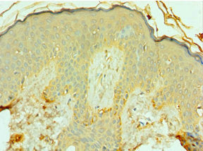 Immunohistochemistry of paraffin-embedded human skin tissue using FOSL1 Antibody at dilution of 1:100Rabbit anti-Human FOSL1 Polyclonal Antibody