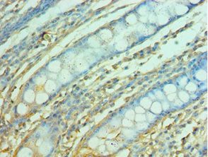 Immunohistochemistry of paraffin-embedded human colon tissue using FOSL1 Antibody at dilution of 1:100Rabbit anti-Human FOSL1 Polyclonal Antibody