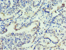 Immunohistochemistry of paraffin-embedded human lung cancer using FOSL2 Antibody at dilution of 1:100Rabbit anti-Human FOSL2 Polyclonal Antibody
