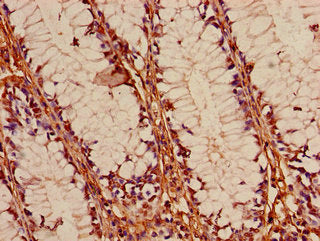 Immunohistochemistry of paraffin-embedded human colon cancer using FOXK1 Antibody at dilution of 1:100Rabbit anti-Human FOXK1 Polyclonal Antibody