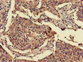 Immunohistochemistry of paraffin-embedded human cervical cancer using FOXN1 Antibody at dilution of 1:100Rabbit anti-Human FOXN1 Polyclonal Antibody