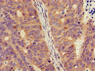 Immunohistochemistry of paraffin-embedded human colon cancer using FPR3 Antibody at dilution of 1:100Rabbit anti-Human FPR3 Polyclonal Antibody