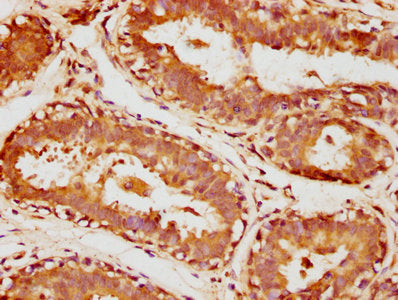 IHC image of the antibody diluted at 1:1000 and staining in paraffin-embedded human breast cancer performed on a Leica BondTM system. After dewaxing and hydration, antigen retrieval was mediated by high pressure in a citrate buffer (pH 6.0). Section was blocked with 10% normal goat serum 30min at RT. Then primary antibody (1% BSA) was incubated at 4°C overnight. The primary is detected by a biotinylated secondary antibody and visualized using an HRP conjugated SP system.Rabbit anti-Human SULT1A3 Polyclonal Antibody