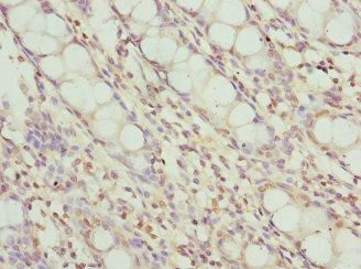 Immunohistochemistry of paraffin-embedded human colon tissue using FRK Antibody at dilution of 1:100Rabbit anti-Human FRK Polyclonal Antibody