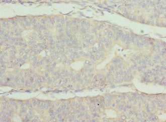 Immunohistochemistry of paraffin-embedded human endometrial cancer using FRK Antibody at dilution of 1:100Rabbit anti-Human FRK Polyclonal Antibody