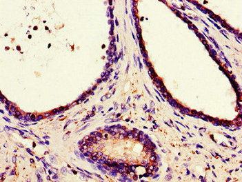 Immunohistochemistry of paraffin-embedded human prostate cancer using CANX Antibody at dilution of 1:100