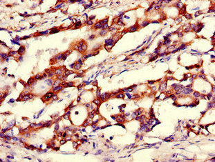 Immunohistochemistry of paraffin-embedded human gastric cancer using CANX Antibody at dilution of 1:100