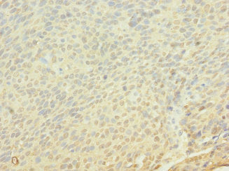 Immunohistochemistry of paraffin-embedded human cervical cancer using FRS3 Antibody at dilution of 1:100Rabbit anti-Human FRS3 Polyclonal Antibody