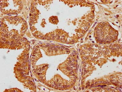 IHC image of the antibody diluted at 1:100 and staining in paraffin-embedded human prostate cancer performed on a Leica BondTM system. After dewaxing and hydration, antigen retrieval was mediated by high pressure in a citrate buffer (pH 6.0). Section was blocked with 10% normal goat serum 30min at RT. Then primary antibody (1% BSA) was incubated at 4°C overnight. The primary is detected by a biotinylated secondary antibody and visualized using an HRP conjugated SP system.Rabbit anti-Human SKOR2 Polyclonal Antibody