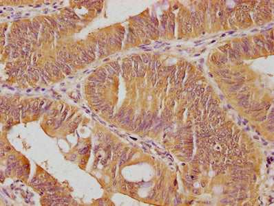 IHC image of SKOR2 Antibody diluted at 1:100 and staining in paraffin-embedded human colon cancer performed on a Leica BondTM system. After dewaxing and hydration, antigen retrieval was mediated by high pressure in a citrate buffer (pH 6.0). Section was blocked with 10% normal goat serum 30min at RT. Then primary antibody (1% BSA) was incubated at 4°C overnight. The primary is detected by a biotinylated secondary antibody and visualized using an HRP conjugated SP system.Rabbit anti-Human SKOR2 Polyclonal Antibody