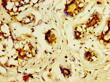 IHC image of LRP2 Antibody diluted at 1:600 and staining in paraffin-embedded human breast cancer performed on a Leica BondTM system. After dewaxing and hydration, antigen retrieval was mediated by high pressure in a citrate buffer (pH 6.0). Section was blocked with 10% normal goat serum 30min at RT. Then primary antibody (1% BSA) was incubated at 4°C overnight. The primary is detected by a biotinylated secondary antibody and visualized using an HRP conjugated SP system.