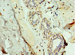 Immunohistochemistry of paraffin-embedded human breast cancer using the antibody at dilution of 1:100Rabbit anti-Human FUT6 Polyclonal Antibody
