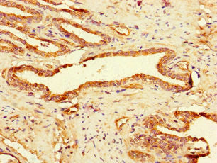 Immunohistochemistry of paraffin-embedded human prostate cancer using the antibody at dilution of 1:100Rabbit anti-Human GAA Polyclonal Antibody