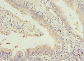 Immunohistochemistry of paraffin-embedded human lung cancer using GABRR1 Antibody at dilution of 1:100Rabbit anti-Human GABRR1 Polyclonal Antibody