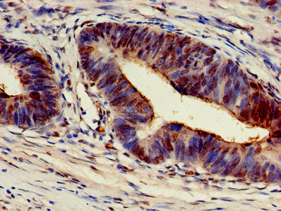 Immunohistochemistry of paraffin-embedded human colon cancer using ARF4 Antibody at dilution of 1:100Rabbit anti-Human ARF4 Polyclonal Antibody