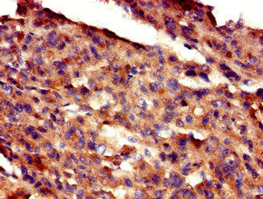 Immunohistochemistry of paraffin-embedded human melanoma using GAS7 Antibody at dilution of 1:100Rabbit anti-Human GAS7 Polyclonal Antibody