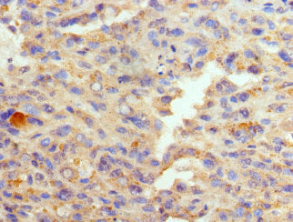 Immunohistochemistry of paraffin-embedded human melanoma using GATA1 Antibody at dilution of 1:100Rabbit anti-Human GATA1 Polyclonal Antibody