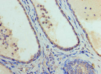 Immunohistochemistry of paraffin-embedded human prostate cancer using GATA1 Antibody at dilution of 1:100Rabbit anti-Human GATA1 Polyclonal Antibody