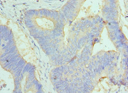 Immunohistochemistry of paraffin-embedded human colon cancer using GC Antibody at dilution of 1:100Rabbit anti-Human GC Polyclonal Antibody