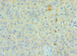 Immunohistochemistry of paraffin-embedded human liver cancer using GC Antibody at dilution of 1:100Rabbit anti-Human GC Polyclonal Antibody