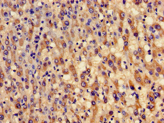 Immunohistochemistry of paraffin-embedded human liver cancer using GCLM Antibody at dilution of 1:100Rabbit anti-Human GCLM Polyclonal Antibody