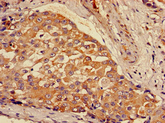 Immunohistochemistry of paraffin-embedded human breast cancer using GCLM Antibody at dilution of 1:100Rabbit anti-Human GCLM Polyclonal Antibody