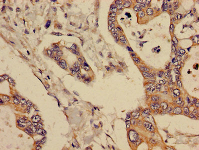 Immunohistochemistry of paraffin-embedded human pancreatic cancer using GCNT3 Antibody at dilution of 1:100Rabbit anti-Human GCNT3 Polyclonal Antibody