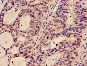 Immunohistochemistry of paraffin-embedded human colon cancer using GCNT3 Antibody at dilution of 1:100Rabbit anti-Human GCNT3 Polyclonal Antibody