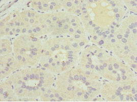 Immunohistochemistry of paraffin-embedded human liver cancer using GDAP1 Antibody at dilution of 1:100Rabbit anti-Human GDAP1 Polyclonal Antibody