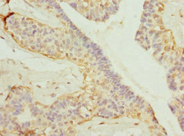 Immunohistochemistry of paraffin-embedded human breast cancer using GDAP1 Antibody at dilution of 1:100Rabbit anti-Human GDAP1 Polyclonal Antibody