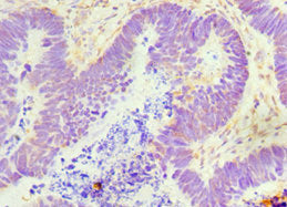 Immunohistochemistry of paraffin-embedded human ovarian cancer using the antibody at dilution of 1:100Rabbit anti-Human GDF5 Polyclonal Antibody