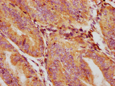IHC image of GDF5 Antibody diluted at 1:132 and staining in paraffin-embedded human endometrial cancer performed on a Leica BondTM system. After dewaxing and hydration, antigen retrieval was mediated by high pressure in a citrate buffer (pH 6.0). Section was blocked with 10% normal goat serum 30min at RT. Then primary antibody (1% BSA) was incubated at 4°C overnight. The primary is detected by a biotinylated secondary antibody and visualized using an HRP conjugated SP system.Rabbit anti-Human GDF5 Polyclonal Antibody