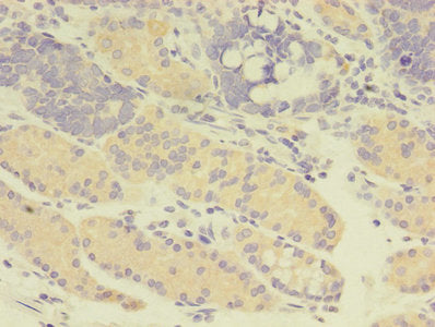 Immunohistochemistry of paraffin-embedded human gastric cancer using GDI2 Antibody at dilution of 1:100Rabbit anti-Human GDI2 Polyclonal Antibody