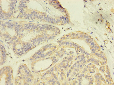 Immunohistochemistry of paraffin-embedded human breast cancer using GDI2 Antibody at dilution of 1:100Rabbit anti-Human GDI2 Polyclonal Antibody
