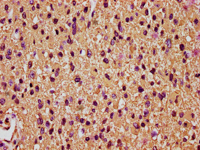 IHC image of GFAP Antibody diluted at 1:200 and staining in paraffin-embedded human glioma performed on a Leica BondTM system. After dewaxing and hydration, antigen retrieval was mediated by high pressure in a citrate buffer (pH 6.0). Section was blocked with 10% normal goat serum 30min at RT. Then primary antibody (1% BSA) was incubated at 4°C overnight. The primary is detected by a biotinylated secondary antibody and visualized using an HRP conjugated SP system.Rabbit anti-Human GFAP Polyclonal Antibody