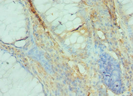 Immunohistochemistry of paraffin-embedded human colon cancer using GFER Antibody at dilution of 1:100Rabbit anti-Human GFER Polyclonal Antibody